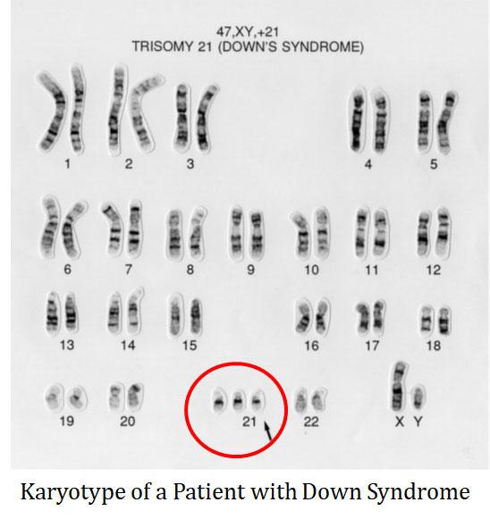 karyotype of down syndrome