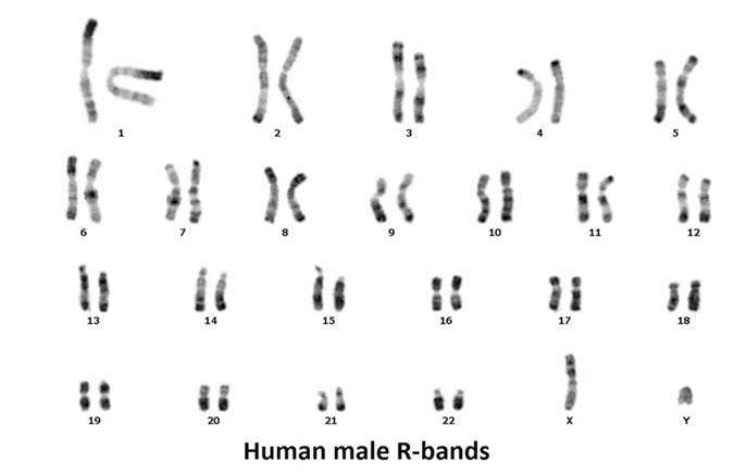 what is r banding in chromosome